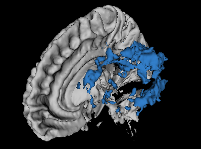 MS lesions and White Matter 3D representation