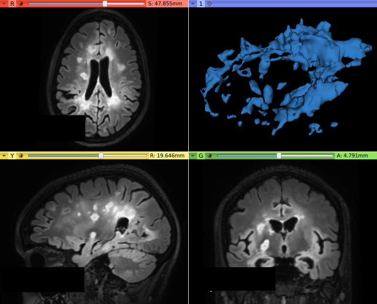 T2-FLAIR image with hyperintense MS lesion contrast enhanced by the LS Contrast Enhancer module