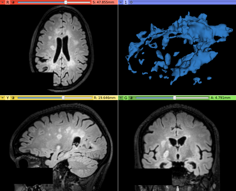 T2-FLAIR image with original lesion contrast