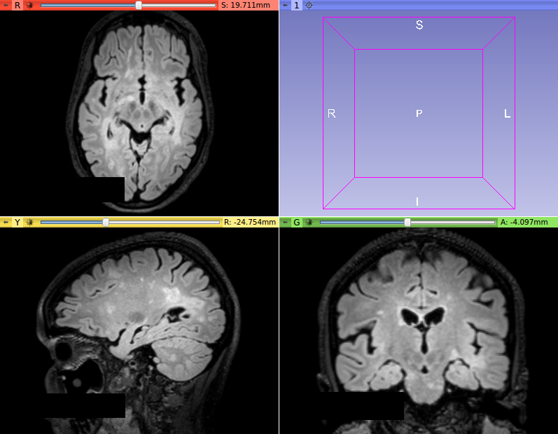 T2-FLAIR image from a MS patient