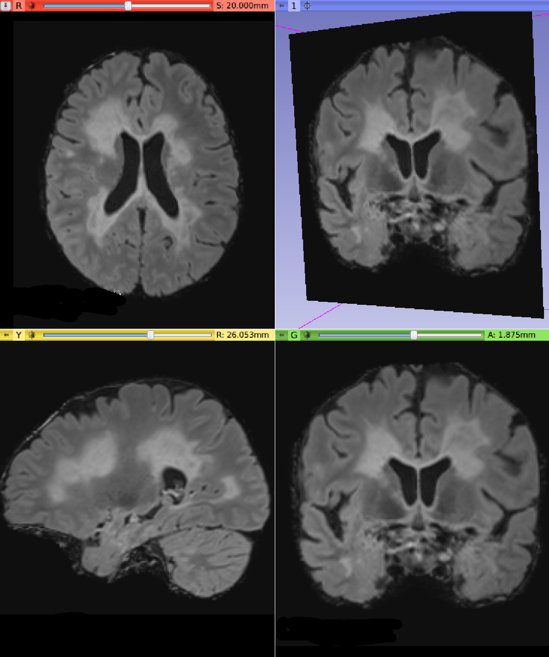 Input T2-FLAIR image with Multiple Sclerosis lesions