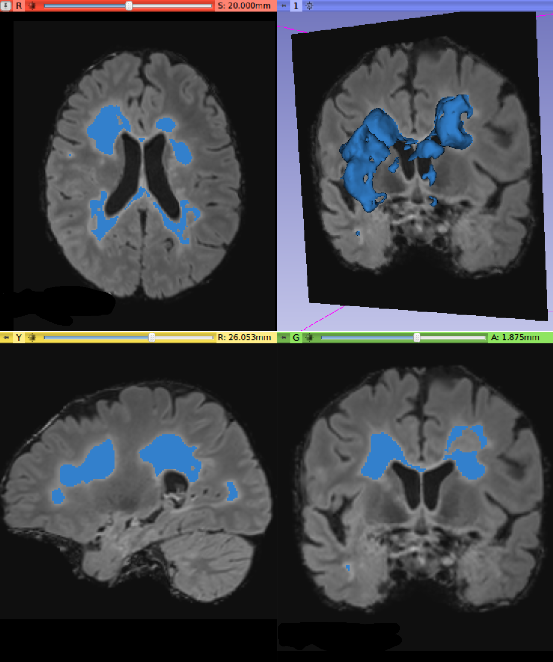 Lesion map resulted from AFT Segmenter module